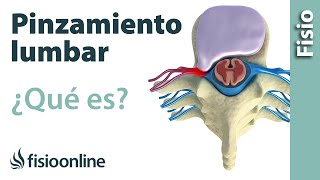 Pinzamiento lumbar - ¿Qué es?