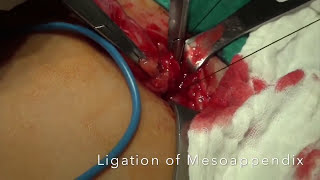 Лечение аппендицита. Аппендэктомия