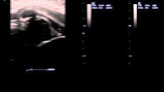 Двухсторонний вывих тазобедренных суставов новорожденного