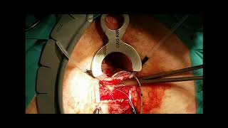 Ligation of Intersphincteric Fistula Tract (LIFT) procedure for the treatment of fistula-in-ano