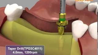 HIOSSEN OSSTEM ETIII System surgical procedures