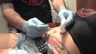 Treating an Infected Belly Button