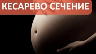 Безопасно ли кесарево сечение? Отвечает акушер гинеколог ПМЦ Мать и Дитя.