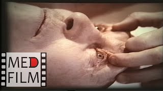 Наркоз барбитуратами © Anesthesia barbiturates