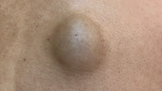 微創超巨型粉瘤手術 美麗新城診所莊禮謙醫師 huge epidermal cyst minimal incision Dr George
