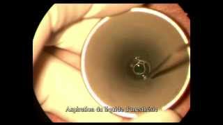 Pose d'un T Tube dans le tympan pour traiter une otite séro-muqueuse