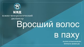 365  Вросший волос в паху