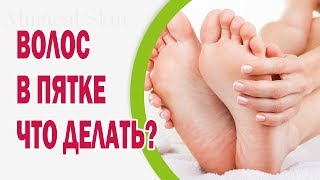 Волос в пятке: что делать