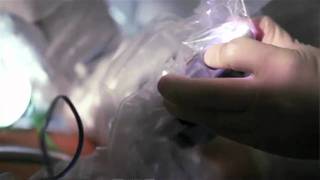 Cardiology: Minimally invasive heart bypass surgery with the da Vinci surgical robot