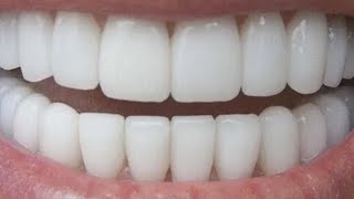 كيف يكون لديك أسنان بيضاء طبيعية في 3 دقائق (يعمل 100%)في المنزل