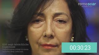 Remescar Tränensäcke und Augenringe - Schweiz - Live Demo Isabel