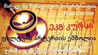 ეკგ პრაქტიკა #2-  მარჯვენა წინაგულის ჰიპერტროფია (ღრმა ვენების თრომბოზის გამო) P-pulmonale