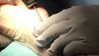 T-Pin Operative Technique