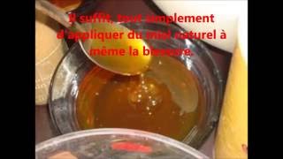 15° Soigner des plaies
