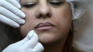 Princess Volume, обучение контурной пластике в Корнеаль