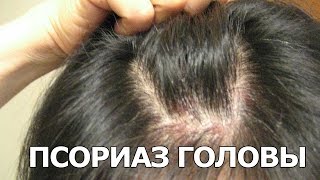 Псориаз на голове