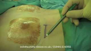 Tuberous Breasts Correction and Breast Enlargement