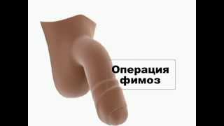 Фимоз-операция