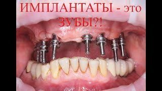 Пример протезирования на имплантатах. На 07.07 тест-драйв новых зубов - проверка на прочность!