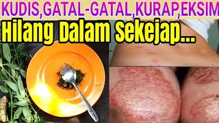 Tidak Banyak Yang Tahu,,,Sakit Kulit Dan Gatal Gatal Menahun Hilang Seketika Dengan Obat Herbal Ini.