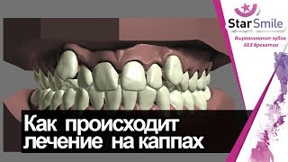 Скученность зубов. Как двигаются зубы при лечении на элайнерах Star Smile