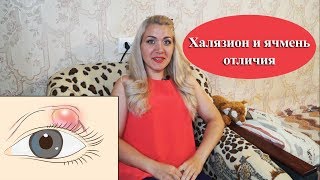 Чем отличается Халязион и Ячмень на глазу, как лечить? Анюта Журило