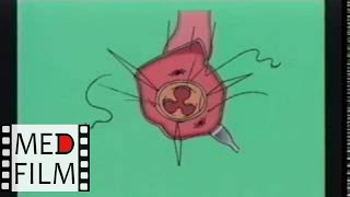 Замена аортального клапана аллографтом © Replacement of the aortic valve allografts