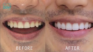 ทำวีเนียร์ ออกแบบรอยยิ้ม Smile design ความแตกต่าง ก่อนและหลังทำ | COSDENT by SLC