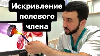 Кривой член. Искривление полового члена. Все, что нужно знать!!!!