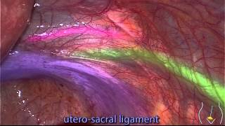 Laparoscopic Anatomy - WITH labels