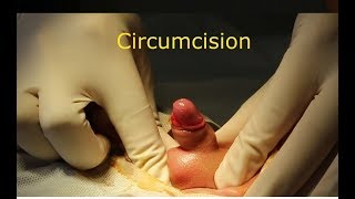 Circumcision: A Simple Procedure that Requires a Simple Technique