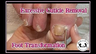 ? How to Remove Excessive Cuticle Buildup, Callus Removal and Foot Massage ??