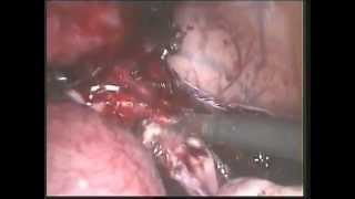 Double Uterus - Laparoscopic hysterectomy