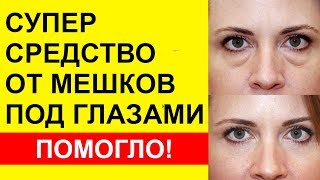 КАК УБРАТЬ МЕШКИ ПОД ГЛАЗАМИ? Как убрать отеки лица и мешки под глазами в домашних условиях