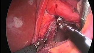 Laparoscopic Nissen Fundoplication