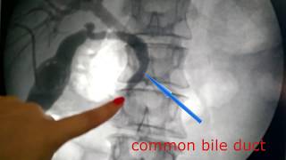 x-ray.Pancreatic cancer/Рак поджелудочной железы.