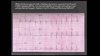 ეკგ- მძღოლი გულის არეში ტკივილით/ გულის არეში ჩხვლეტა / ECG / EKG