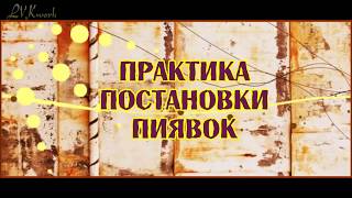 Практика постановки пиявок