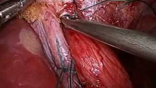 laparoscopic fundoplication for heartburn by Dr Craig Taylor Sydney