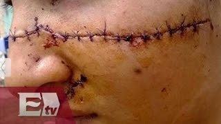 Desfiguran el rostro de una jovencita argentina por hermosa/ Global