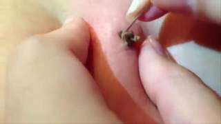 УДАЛЕНИЕ БОЛЬШОЙ ЧЕРНОЙ ТОЧКИ НА ТЕЛЕ