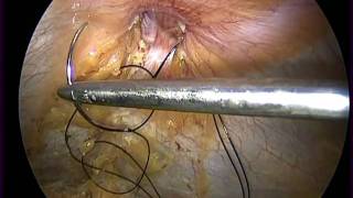umbilical hernia