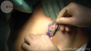 Breast sentinel node biopsy • Oncolex