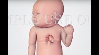 Hypoplastic Left Heart Syndrome | HLHS | Nucleus Health