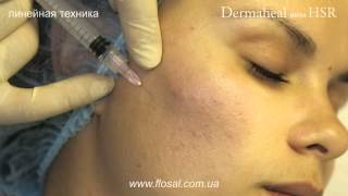 Dermaheal meso HSR - линейная техника введения препарата [ FloSal ]