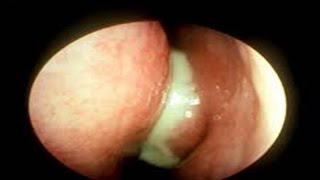 ACUTE MAXILLARY SINUSITIS DR.FOHEID ALSOBEI