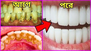 শুধুমাত্র ২ মিনিটে দাঁতের টার্টার ও দাঁতের প্লাক দূর করে নিতে পারবেন।দাঁত ঝকঝকে করার টিপস।