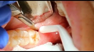90 Second Non Invasive Wisdom Tooth Extraction Procedure