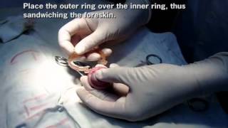 No-Needle Local Anesthesia for the ShangRing Circumcision