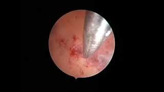 Art of hysteroscopy by osama shawki, arcuate uterus reconstruction